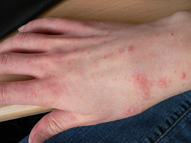 Papules caused by scabies